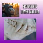 Prognathism